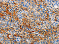 The image on the left is immunohistochemistry of paraffin-embedded Human liver cancer tissue using CSB-PA477062(STAMBP Antibody) at dilution 1/15, on the right is treated with fusion protein. (Original magnification: ×200)
