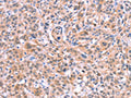 The image on the left is immunohistochemistry of paraffin-embedded Human esophagus cancer tissue using CSB-PA477402(BMPR2 Antibody) at dilution 1/35, on the right is treated with fusion protein. (Original magnification: ×200)