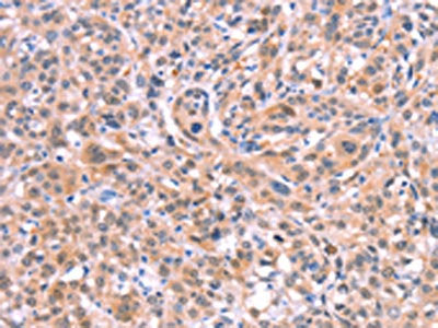 The image on the left is immunohistochemistry of paraffin-embedded Human esophagus cancer tissue using CSB-PA477402(BMPR2 Antibody) at dilution 1/35, on the right is treated with fusion protein. (Original magnification: ×200)