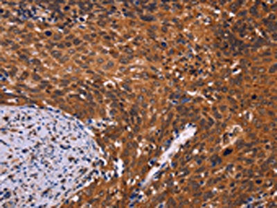 The image on the left is immunohistochemistry of paraffin-embedded Human cervical cancer tissue using CSB-PA478063(CDC5L Antibody) at dilution 1/40, on the right is treated with fusion protein. (Original magnification: ×200)
