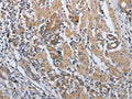 The image on the left is immunohistochemistry of paraffin-embedded Human gastic cancer tissue using CSB-PA483633(PDCD1 Antibody) at dilution 1/50, on the right is treated with synthetic peptide. (Original magnification: ×200)