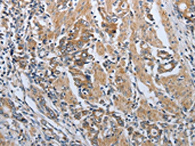 The image on the left is immunohistochemistry of paraffin-embedded Human gastic cancer tissue using CSB-PA483633(PDCD1 Antibody) at dilution 1/50, on the right is treated with synthetic peptide. (Original magnification: ×200)
