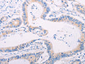 The image on the left is immunohistochemistry of paraffin-embedded Human colon cancer tissue using CSB-PA485300(ADAMTS17 Antibody) at dilution 1/60, on the right is treated with synthetic peptide. (Original magnification: ×200)