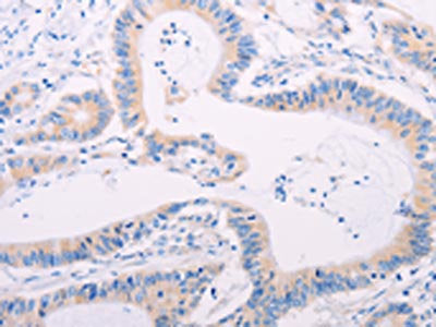 The image on the left is immunohistochemistry of paraffin-embedded Human colon cancer tissue using CSB-PA485300(ADAMTS17 Antibody) at dilution 1/60, on the right is treated with synthetic peptide. (Original magnification: ×200)