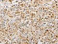 The image on the left is immunohistochemistry of paraffin-embedded Human thyroid cancer tissue using CSB-PA493084(SAE1 Antibody) at dilution 1/20, on the right is treated with fusion protein. (Original magnification: ×200)