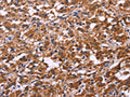 The image on the left is immunohistochemistry of paraffin-embedded Human thyroid cancer tissue using CSB-PA503322(SPATA7 Antibody) at dilution 1/30, on the right is treated with fusion protein. (Original magnification: ×200)