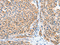 The image on the left is immunohistochemistry of paraffin-embedded Human liver cancer tissue using CSB-PA505238(CASP7 Antibody) at dilution 1/20, on the right is treated with fusion protein. (Original magnification: X200)