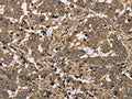 The image on the left is immunohistochemistry of paraffin-embedded Human liver cancer tissue using CSB-PA505319(IKBIP Antibody) at dilution 1/30, on the right is treated with fusion protein. (Original magnification: ×200)