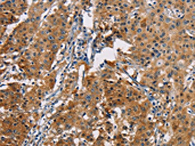 The image on the left is immunohistochemistry of paraffin-embedded Human gastric cancer tissue using CSB-PA511971(PDCD1LG2 Antibody) at dilution 1/50, on the right is treated with fusion protein. (Original magnification: ×200)