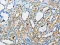 The image on the left is immunohistochemistry of paraffin-embedded Human thyroid cancer tissue using CSB-PA514644(ARSA Antibody) at dilution 1/50, on the right is treated with fusion protein. (Original magnification: ×200)