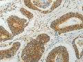 The image on the left is immunohistochemistry of paraffin-embedded Human colon cancer tissue using CSB-PA516472(CCND1 Antibody) at dilution 1/50, on the right is treated with fusion protein. (Original magnification: ×200)