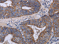 The image on the left is immunohistochemistry of paraffin-embedded Human colon cancer tissue using CSB-PA520082(MT3 Antibody) at dilution 1/50, on the right is treated with fusion protein. (Original magnification: ×200)