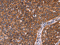 The image on the left is immunohistochemistry of paraffin-embedded Human cervical cancer tissue using CSB-PA520696(CCDC106 Antibody) at dilution 1/60, on the right is treated with fusion protein. (Original magnification: ×200)