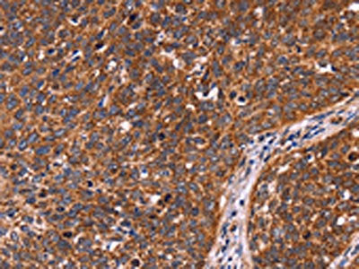 The image on the left is immunohistochemistry of paraffin-embedded Human cervical cancer tissue using CSB-PA520696(CCDC106 Antibody) at dilution 1/60, on the right is treated with fusion protein. (Original magnification: ×200)