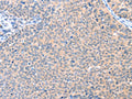 The image on the left is immunohistochemistry of paraffin-embedded Human cervical cancer tissue using CSB-PA521729(AADACL2 Antibody) at dilution 1/25, on the right is treated with fusion protein. (Original magnification: ×200)