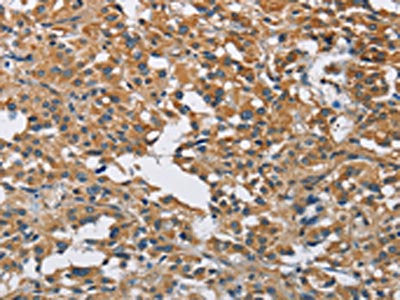 The image on the left is immunohistochemistry of paraffin-embedded Human thyroid cancer tissue using CSB-PA522891(DNMT3A Antibody) at dilution 1/50, on the right is treated with fusion protein. (Original magnification: ×200)