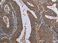 The image on the left is immunohistochemistry of paraffin-embedded Human colon cancer tissue using CSB-PA523947(LCMT1 Antibody) at dilution 1/20, on the right is treated with fusion protein. (Original magnification: ×200)