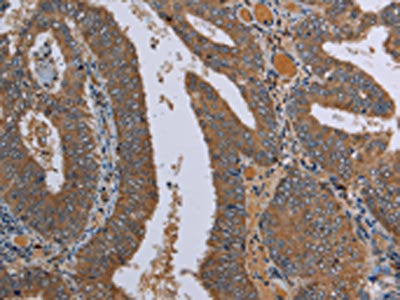 The image on the left is immunohistochemistry of paraffin-embedded Human colon cancer tissue using CSB-PA523947(LCMT1 Antibody) at dilution 1/20, on the right is treated with fusion protein. (Original magnification: ×200)