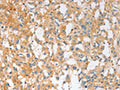 The image on the left is immunohistochemistry of paraffin-embedded Human thyroid cancer tissue using CSB-PA524180(EPS15L1 Antibody) at dilution 1/30, on the right is treated with fusion protein. (Original magnification: ×200)