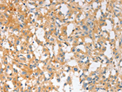 The image on the left is immunohistochemistry of paraffin-embedded Human thyroid cancer tissue using CSB-PA524180(EPS15L1 Antibody) at dilution 1/30, on the right is treated with fusion protein. (Original magnification: ×200)