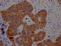 IHC image of CSB-PA527261LA01HU diluted at 1:100 and staining in paraffin-embedded human ovarian cancer performed on a Leica BondTM system. After dewaxing and hydration, antigen retrieval was mediated by high pressure in a citrate buffer (pH 6.0). Section was blocked with 10% normal goat serum 30min at RT. Then primary antibody (1% BSA) was incubated at 4°C overnight. The primary is detected by a Goat anti-rabbit polymer IgG labeled by HRP and visualized using 0.05% DAB.