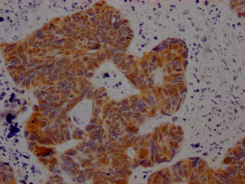 IHC image of CSB-PA527261LA01HU diluted at 1:100 and staining in paraffin-embedded human ovarian cancer performed on a Leica BondTM system. After dewaxing and hydration, antigen retrieval was mediated by high pressure in a citrate buffer (pH 6.0). Section was blocked with 10% normal goat serum 30min at RT. Then primary antibody (1% BSA) was incubated at 4°C overnight. The primary is detected by a Goat anti-rabbit polymer IgG labeled by HRP and visualized using 0.05% DAB.