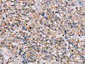 The image on the left is immunohistochemistry of paraffin-embedded Human prostate cancer tissue using CSB-PA533274(ADAM12 Antibody) at dilution 1/40, on the right is treated with synthetic peptide. (Original magnification: ×200)