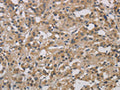 The image on the left is immunohistochemistry of paraffin-embedded Human thyroid cancer tissue using CSB-PA542036(DCN Antibody) at dilution 1/30, on the right is treated with fusion protein. (Original magnification: ×200)