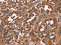 The image on the left is immunohistochemistry of paraffin-embedded Human gastic cancer tissue using CSB-PA545107(NOS2 Antibody) at dilution 1/40, on the right is treated with fusion protein. (Original magnification: ×200)