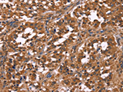 The image on the left is immunohistochemistry of paraffin-embedded Human gastic cancer tissue using CSB-PA545107(NOS2 Antibody) at dilution 1/40, on the right is treated with fusion protein. (Original magnification: ×200)