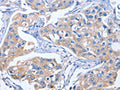 The image on the left is immunohistochemistry of paraffin-embedded Human breast cancer tissue using CSB-PA545336(IBSP Antibody) at dilution 1/50, on the right is treated with synthetic peptide. (Original magnification: ×200)
