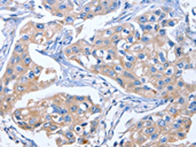The image on the left is immunohistochemistry of paraffin-embedded Human breast cancer tissue using CSB-PA545336(IBSP Antibody) at dilution 1/50, on the right is treated with synthetic peptide. (Original magnification: ×200)