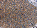 The image on the left is immunohistochemistry of paraffin-embedded Human renal cancer tissue using CSB-PA545915(LIPE Antibody) at dilution 1/50, on the right is treated with fusion protein. (Original magnification: ×200)