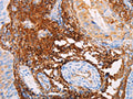 The image on the left is immunohistochemistry of paraffin-embedded Human cervical cancer tissue using CSB-PA546098(TGM2 Antibody) at dilution 1/15, on the right is treated with fusion protein. (Original magnification: ×200)