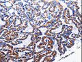 The image is immunohistochemistry of paraffin-embedded Human thyroid cancer tissue using CSB-PA546304(NFKB1 Antibody) at dilution 1/40. (Original magnification: 200)