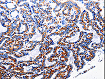 The image is immunohistochemistry of paraffin-embedded Human thyroid cancer tissue using CSB-PA546304(NFKB1 Antibody) at dilution 1/40. (Original magnification: 200)