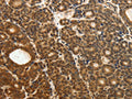The image on the left is immunohistochemistry of paraffin-embedded Human thyroid cancer tissue using CSB-PA546739(ODC1 Antibody) at dilution 1/30, on the right is treated with fusion protein. (Original magnification: ×200)