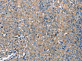 The image on the left is immunohistochemistry of paraffin-embedded Human ovarian cancer tissue using CSB-PA546791(DEFA1 Antibody) at dilution 1/10, on the right is treated with fusion protein. (Original magnification: ×200)