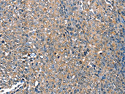The image on the left is immunohistochemistry of paraffin-embedded Human ovarian cancer tissue using CSB-PA546791(DEFA1 Antibody) at dilution 1/10, on the right is treated with fusion protein. (Original magnification: ×200)