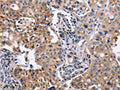 The image on the left is immunohistochemistry of paraffin-embedded Human lung cancer tissue using CSB-PA546880(ITGB5 Antibody) at dilution 1/40, on the right is treated with fusion protein. (Original magnification: ×200)