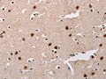 The image on the left is immunohistochemistry of paraffin-embedded Human brain tissue using CSB-PA547116(AKAP8L Antibody) at dilution 1/20, on the right is treated with fusion protein. (Original magnification: ×200)