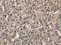 The image on the left is immunohistochemistry of paraffin-embedded Human liver cancer tissue using CSB-PA547426(PGK1 Antibody) at dilution 1/40, on the right is treated with fusion protein. (Original magnification: X200)