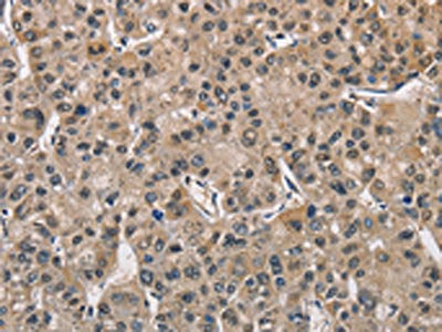 The image on the left is immunohistochemistry of paraffin-embedded Human liver cancer tissue using CSB-PA547426(PGK1 Antibody) at dilution 1/40, on the right is treated with fusion protein. (Original magnification: X200)