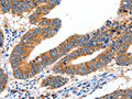 The image on the left is immunohistochemistry of paraffin-embedded Human colon cancer tissue using CSB-PA547464(SLC2A1 Antibody) at dilution 1/40, on the right is treated with synthetic peptide. (Original magnification: ×200)