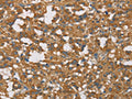 The image on the left is immunohistochemistry of paraffin-embedded Human thyroid cancer tissue using CSB-PA547632(DCTN1 Antibody) at dilution 1/50, on the right is treated with fusion protein. (Original magnification: ×200)