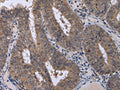 The image on the left is immunohistochemistry of paraffin-embedded Human colon cancer tissue using CSB-PA547925(CDK5 Antibody) at dilution 1/30, on the right is treated with fusion protein. (Original magnification: ×200)