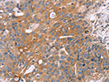 The image on the left is immunohistochemistry of paraffin-embedded Human breast cancer tissue using CSB-PA548038(OPTN Antibody) at dilution 1/25, on the right is treated with fusion protein. (Original magnification: ×200)