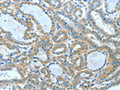 The image on the left is immunohistochemistry of paraffin-embedded Human thyroid cancer tissue using CSB-PA548094(SPHK2 Antibody) at dilution 1/60, on the right is treated with fusion protein. (Original magnification: ×200)