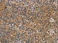 The image on the left is immunohistochemistry of paraffin-embedded Human esophagus cancer tissue using CSB-PA548507(TAC1 Antibody) at dilution 1/25, on the right is treated with fusion protein. (Original magnification: ×200)