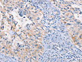 The image on the left is immunohistochemistry of paraffin-embedded Human cervical cancer tissue using CSB-PA548882(CCR5 Antibody) at dilution 1/15, on the right is treated with synthetic peptide. (Original magnification: ×200)